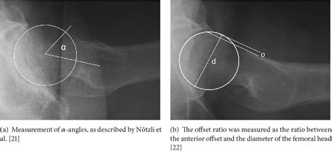 Figure 1 From Prevalence Of Cam And Pincer Deformities In The X Rays Of