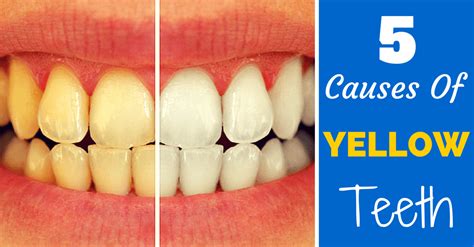 what causes yellow teeth and what to do about it