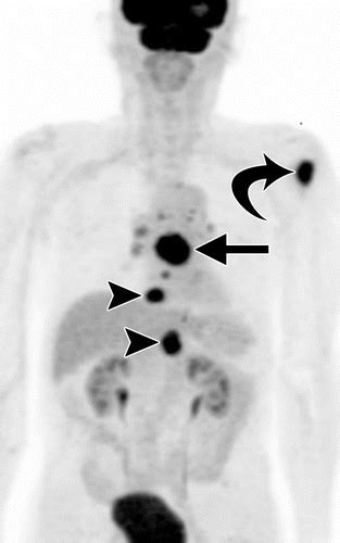 New Tnm Staging System For Esophageal Cancer What Chest Radiologists