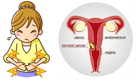 Most Women Miss These 3 Early Signs Of Cervical Cancer Natural Healing