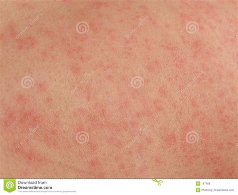 skin rash royalty  stock  image