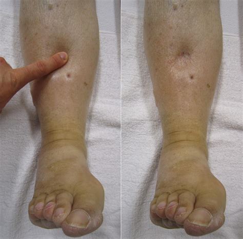 health encylopedia health home page swelling  legs