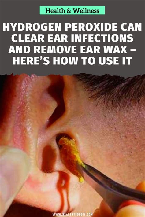 hydrogen peroxide  clear ear infections  remove ear wax heres