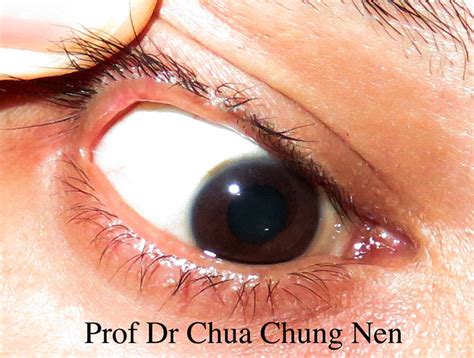 eyelid surgery  prof dr cn chua doctor   remove  lumpy    eye