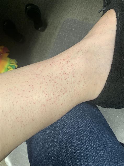 red spots  randomly show    ankles