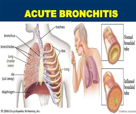 bronchitis symptoms and treatment health and wellness