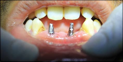 loose bottom front teeth treatment  affordable dental implants  zirconium bridges