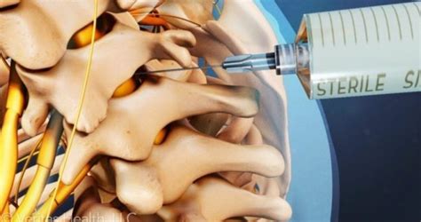 fda warns  dangers  epidural steroid injections   pain easy recipes