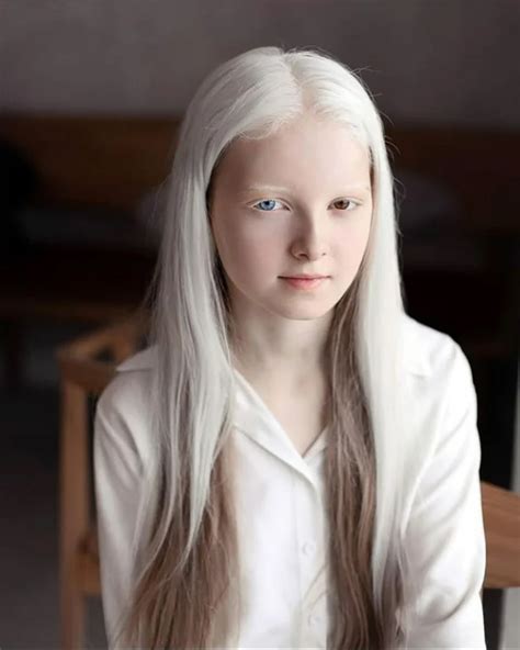 a girl with albinism and heterochromia pics in 2020 albino girl