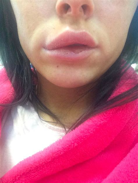 woman feared she d go blind after lip exploded and spread filler