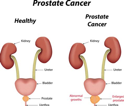 prostate cancer doctors of york pa urology cancer specialists of