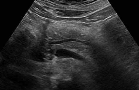 Abdomen And Retroperitoneum 1 3 Pancreas Case 1 3 1 Pancreatic Head