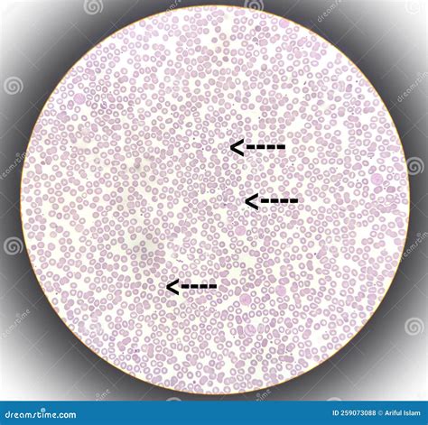 blood smear leishman stained microscopic anemia stock photo image  font blood