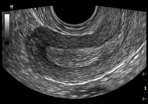 Normal Gynaecological Ultrasound Transvaginal Image