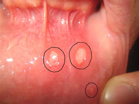 Mouth Ulcers Aphthous Stomatitis Ralev Dental Clinic