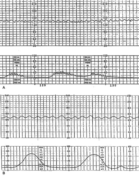 chorioamnionitis and fetal heart strip sex archive