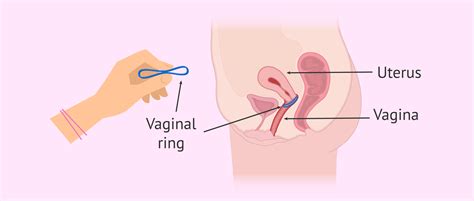 Vaginal Ring As Mean Of Contraception How Does It Work