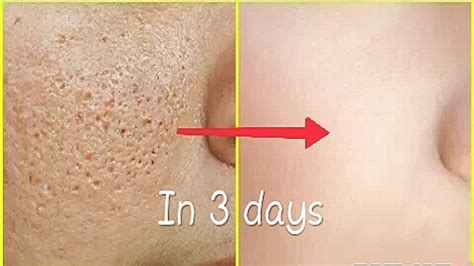 remove face holes fast naturally  clear skin naturally hole  skin youtube