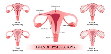 freedom from fibroids without a hysterectomy page 2 of 3