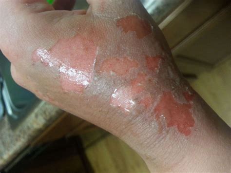 degree burns healing stages pictures  treatment