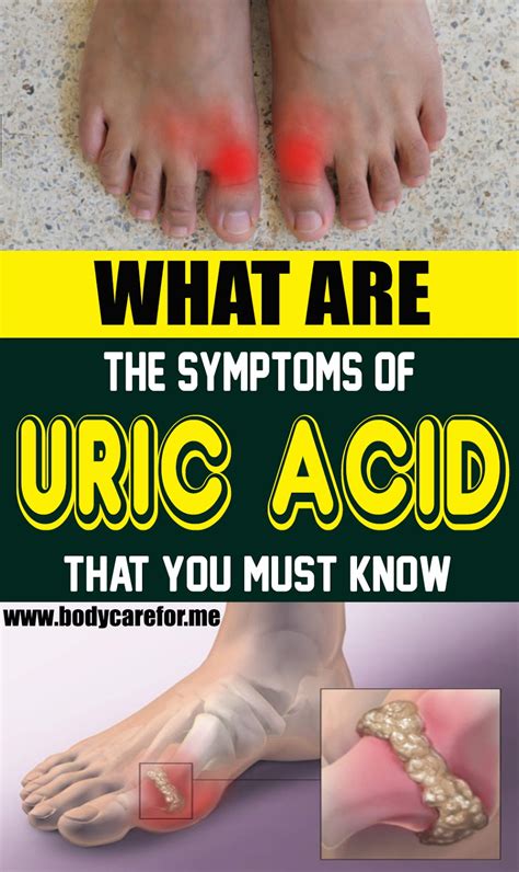 symptoms  uric acid