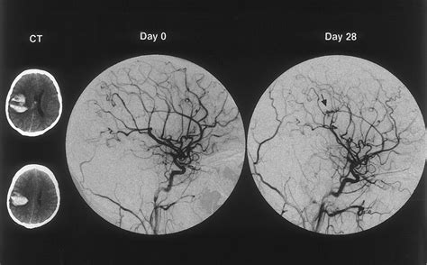 value of repeat angiography in patients with spontaneous