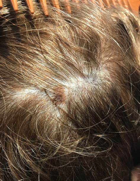 melanoma on scalp pictures early stage scalp melanoma images my xxx