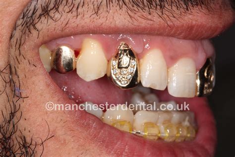 dentist   gold teeth  birmingham teethwalls