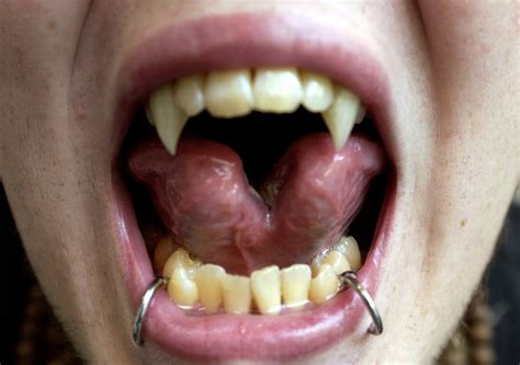 what is tongue splitting trend could have dangerous health risks