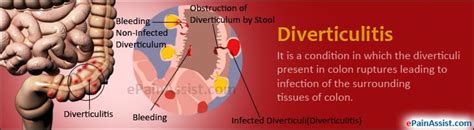 diverticulitis treatment causes symptoms signs risk