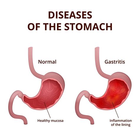 stomach polyps symptoms  diet treatment stdgov blog