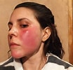 Afbeeldingsresultaten voor "athorybia Rosacea". Grootte: 104 x 100. Bron: www.rosacea.org