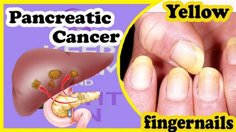 Signs And Symptoms Of Pancreatic Cancer You Should Know Youtube