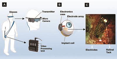 real life story   bionic eye  argus ii