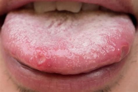 Remedies For Oral Candidiasis Natural Alternatives Step To Health