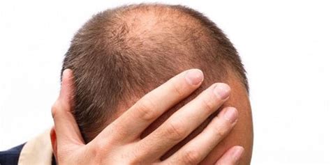 Male Pattern Baldness What Is It And How To Treat It