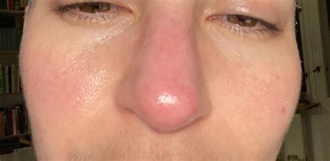 routine     red nose dont   rosacea