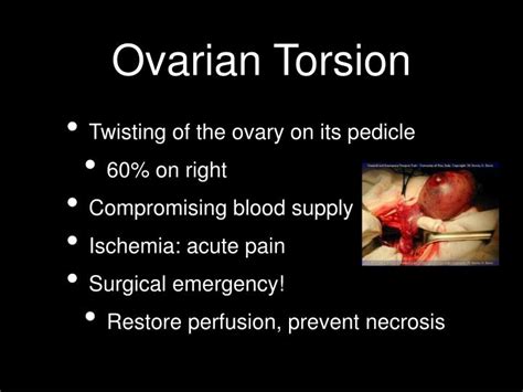 ovarian torsion powerpoint  id