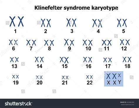 Klinefelter Syndrome Karyotype庫存插圖 263682395 Shutterstock