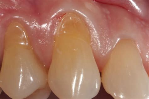 gingival recession  surgical options   considered   patient education