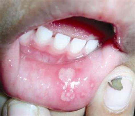Coxsackie Virus Exanthem Hand Foot Mouth Disease