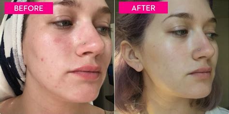 I Gave Up Popping My Pimples For A Week Skincare And Acne Tips
