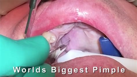 Biggest Pimple In The World Youtube