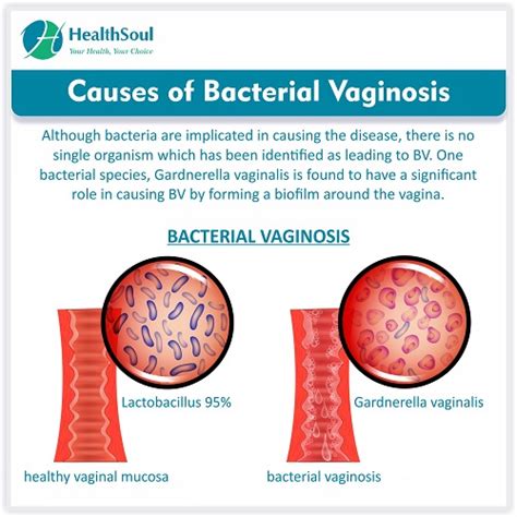 bacterial vaginosis causes symptoms and treatment obstetrics