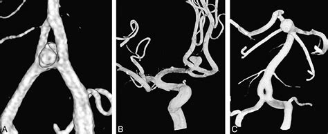 Fenestrations Of Intracranial Arteries Detected With 3d Rotational