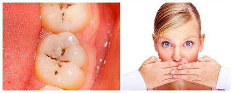 Do Cavities Cause Bad Breath New Health Advisor
