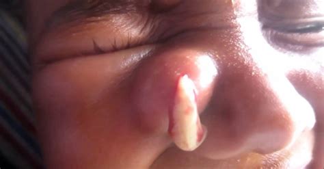 Abscess On Side Of Nose