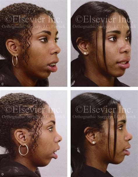 24 bimaxillary dental protrusive growth patterns with