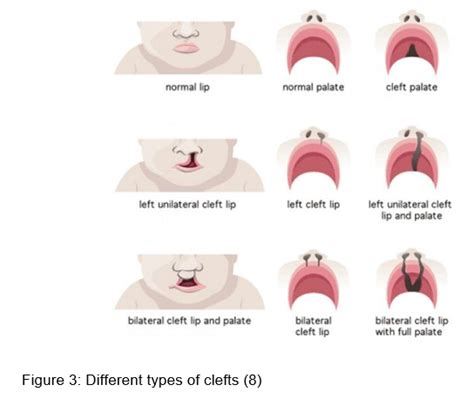 Cleft Lip And Palate In Neonates Safer Care Victoria