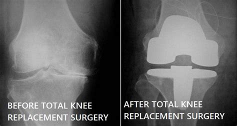 Total Knee Replacement Common Queries Answered Read